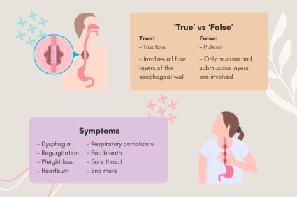 Learn More About the Super Rare Disease – Esophageal Diverticulum